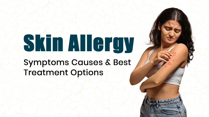 Skin Allergy Symptoms Causes & Best Treatment Options